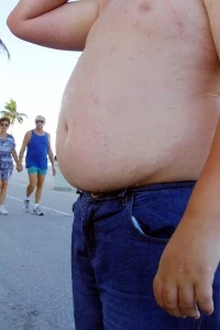 Report Cites Obesity As Major Health Hazard